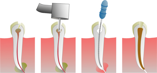 Endodonzia