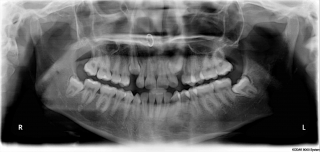 Caso di Ortodonzia - Panoramica